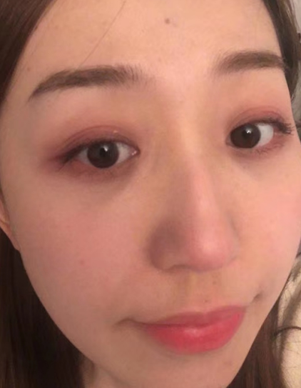 去眼袋手术