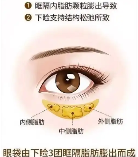 去眼袋手术