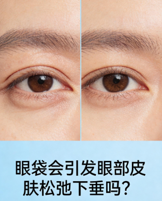 去眼袋手术