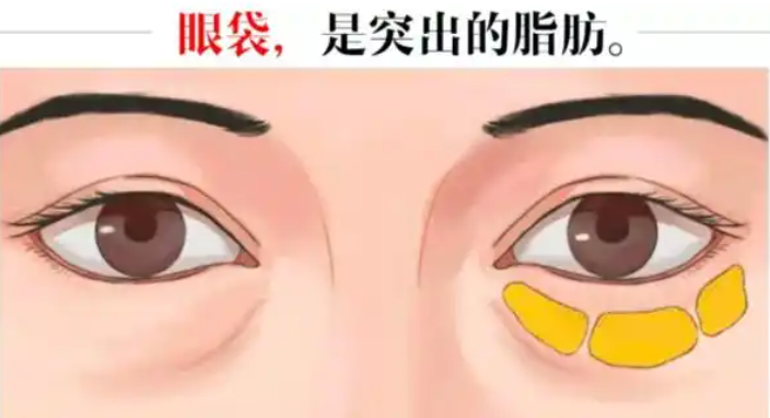去眼袋手术