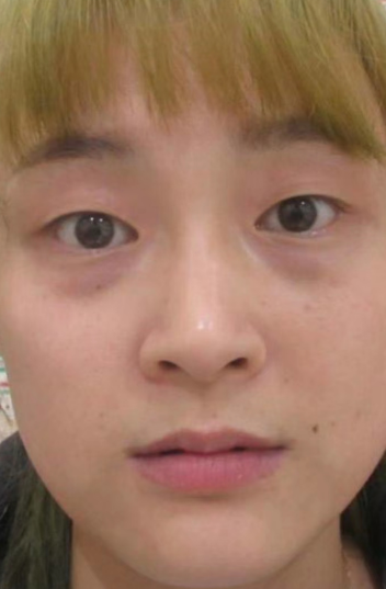 去眼袋手术