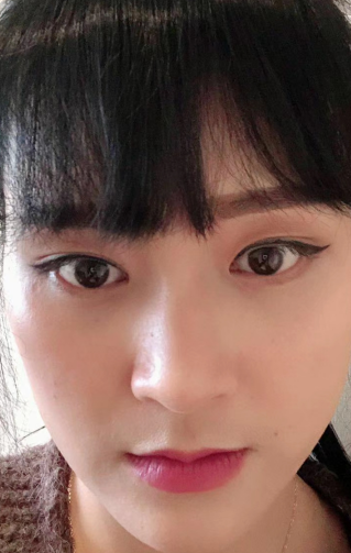 去眼袋手术