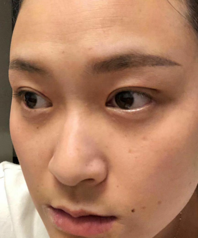 去眼袋手术