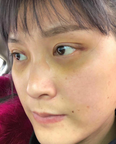 去眼袋手术