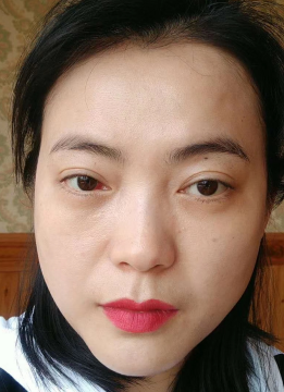 去眼袋手术