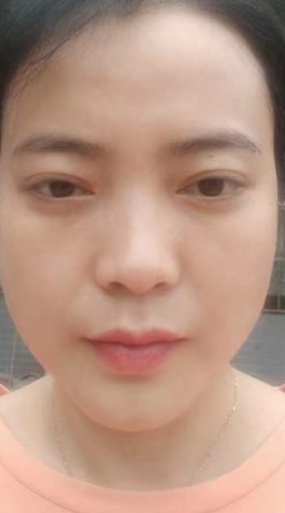 去眼袋手术