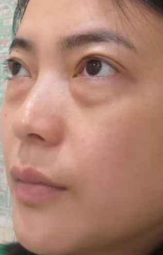 去眼袋手术
