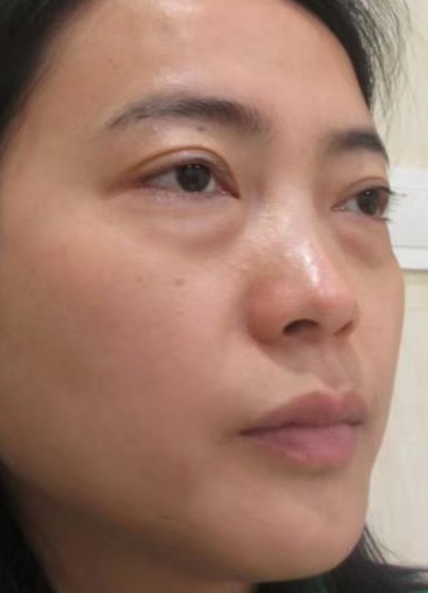去眼袋手术