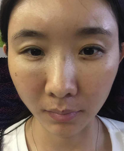 去眼袋手术