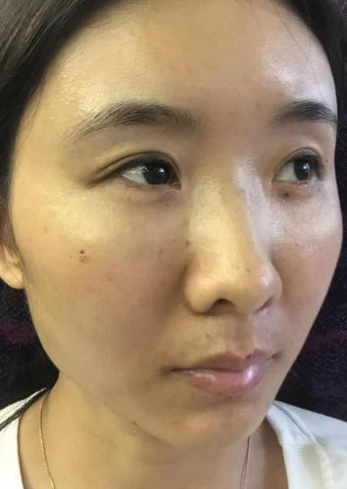 去眼袋手术