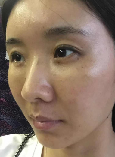 去眼袋手术