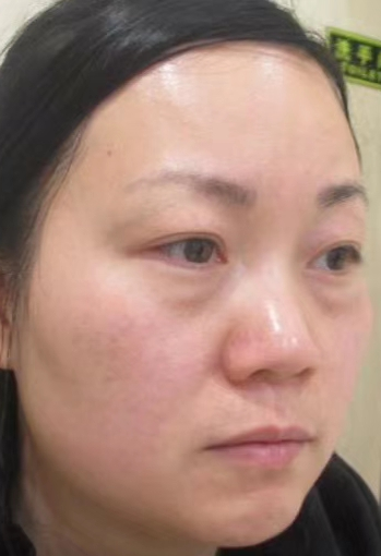 去眼袋手术