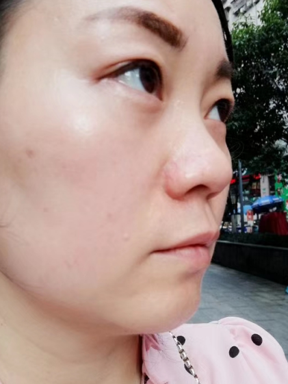 去眼袋手术