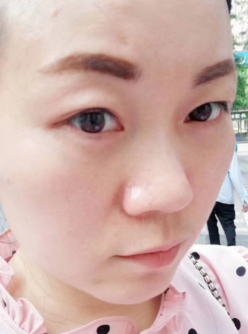 去眼袋手术