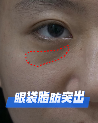 去眼袋手术