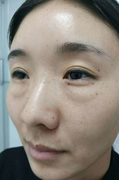 去眼袋手术