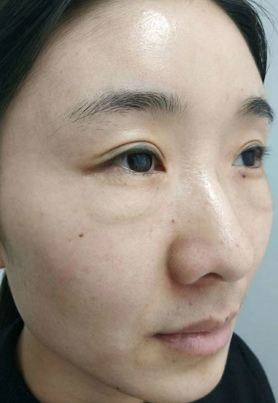 去眼袋手术