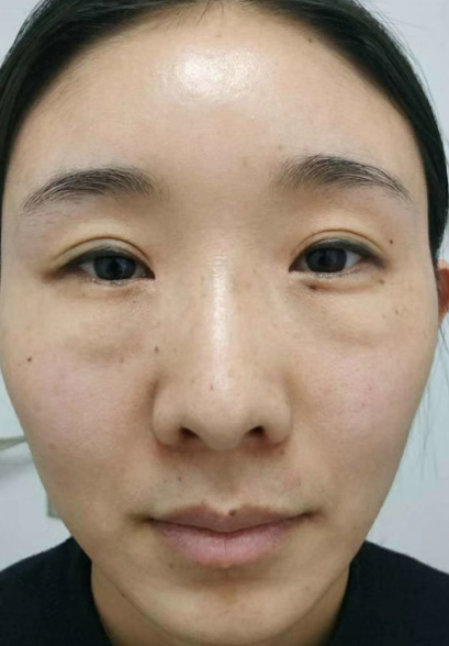 去眼袋手术