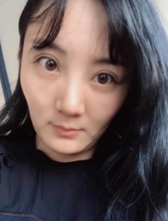 去眼袋手术
