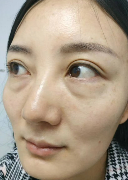 去眼袋手术