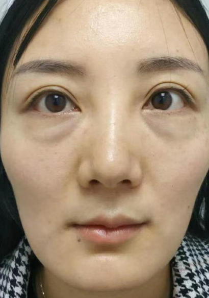 去眼袋手术