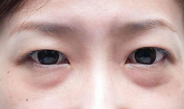 去眼袋手术