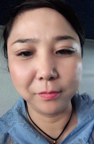 去眼袋手术