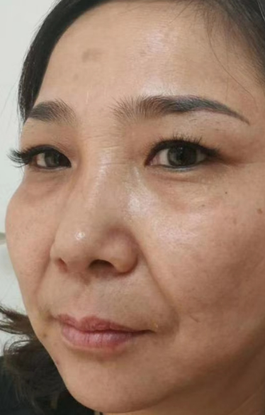 去眼袋手术