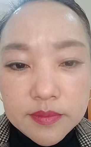 去眼袋手术