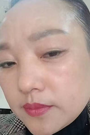 去眼袋手术