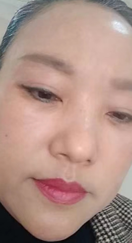 去眼袋手术