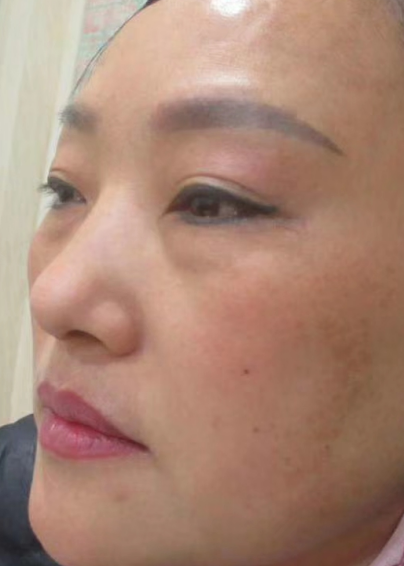 去眼袋手术