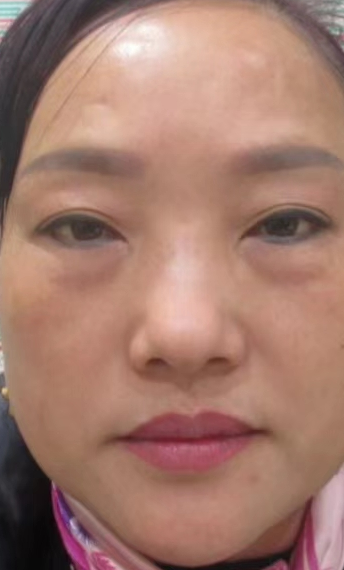 去眼袋手术