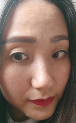 去眼袋手术