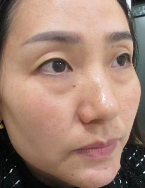 去眼袋手术