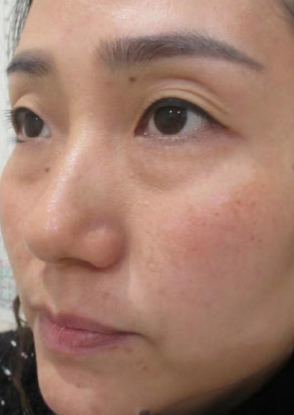 去眼袋手术