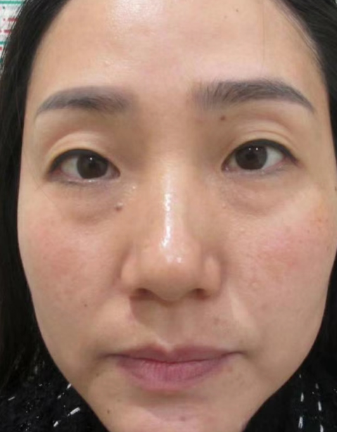去眼袋手术