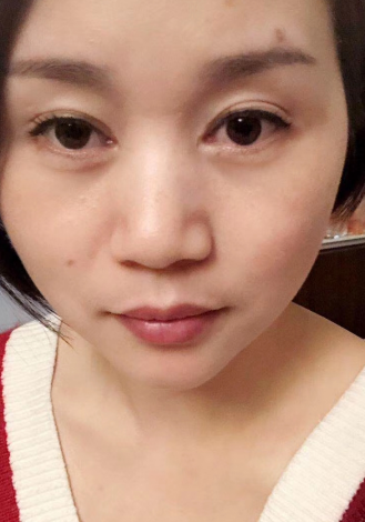 去眼袋手术