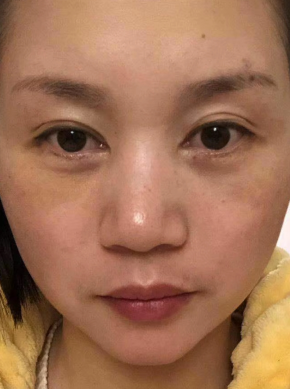 去眼袋手术