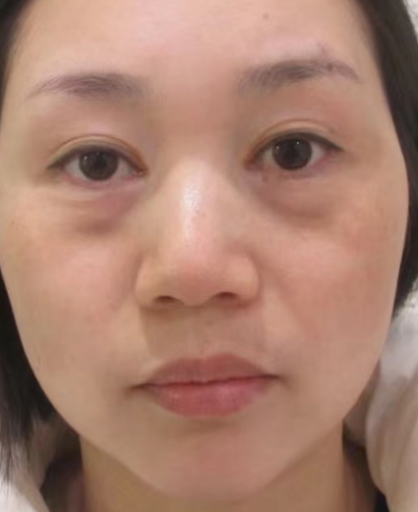 去眼袋手术