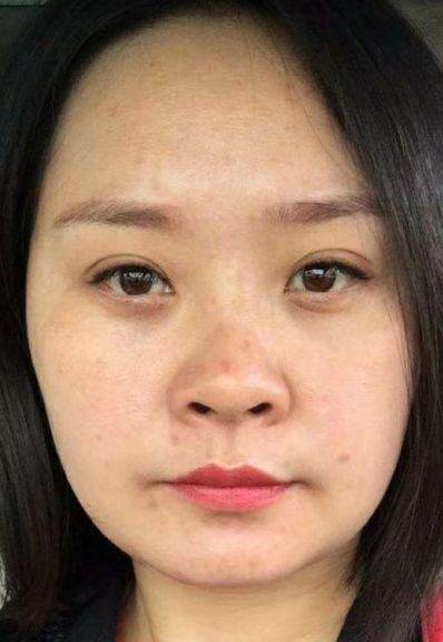 去眼袋手术