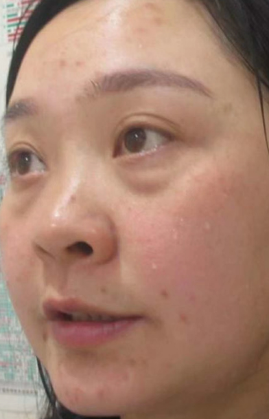 去眼袋手术