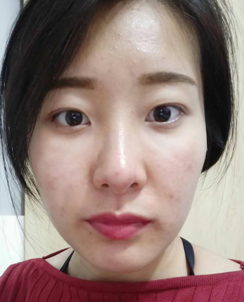 去眼袋手术