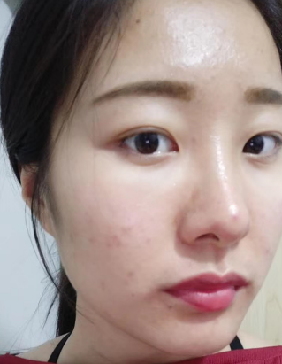 去眼袋手术