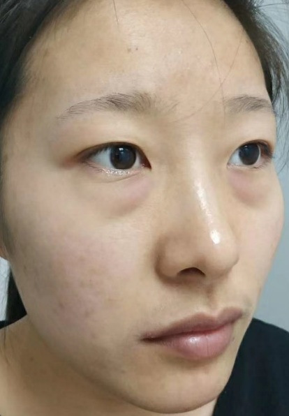 去眼袋手术