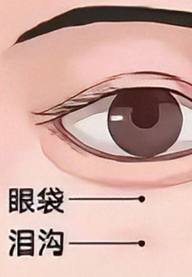 去眼袋手术