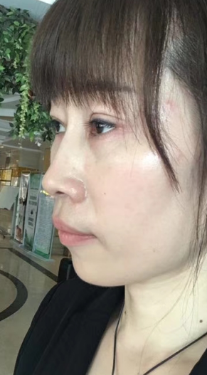 去眼袋手术