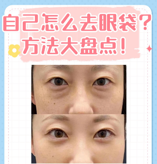 去眼袋手术