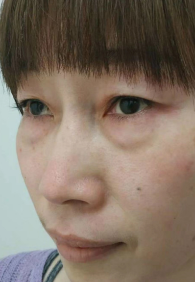 去眼袋手术