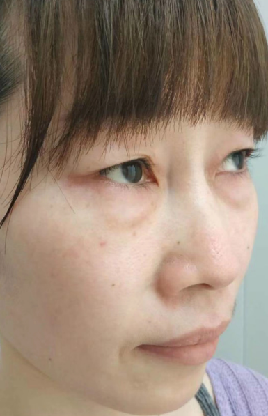 去眼袋手术